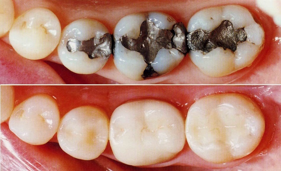 What Is a Tooth Filling and Its Procedure